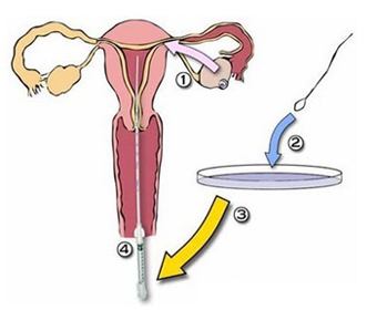 宫腔内人工授精的决定因素是什么？