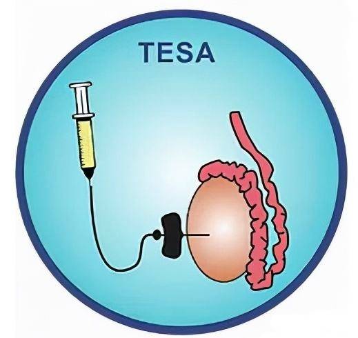 精子提取术TESA、PESA适合哪些情况？有什么优势？