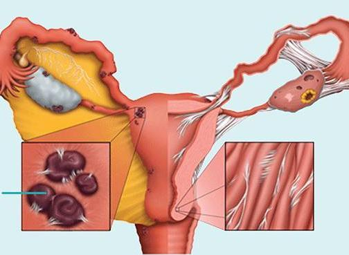 子宫内膜异位症的病因是什么？
