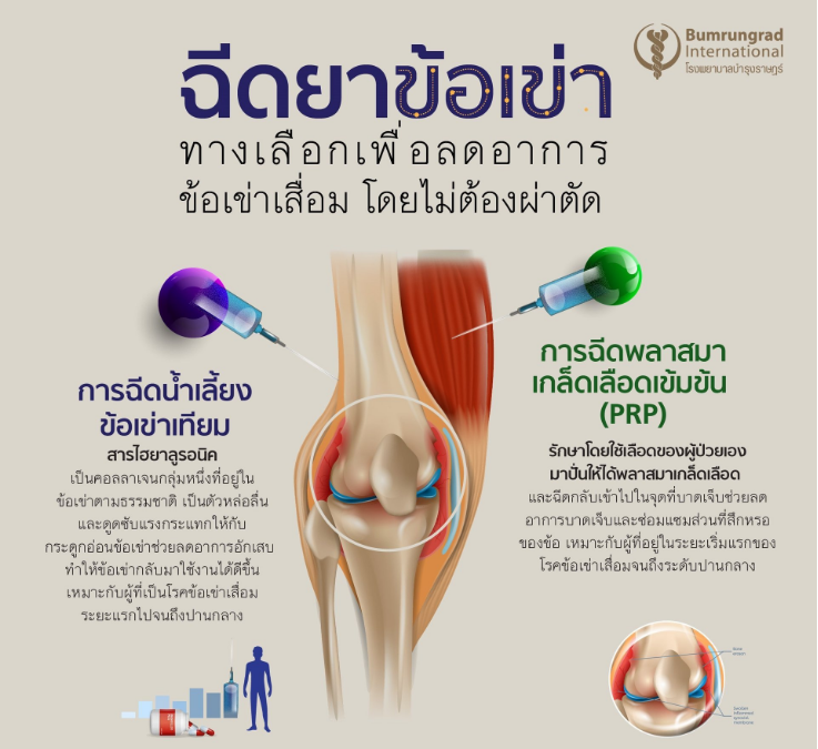 用于治疗膝关节骨质疏松症的治疗方案！远洋康民国际医院中国办事处
